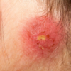 Common Contagious Skin Diseases Infections