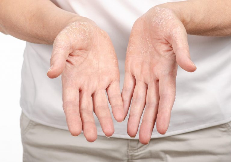 How to Beat Irritant Dermatitis During COVID-19