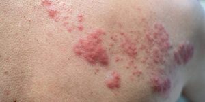 5 Common Contagious Skin Diseases & Infections