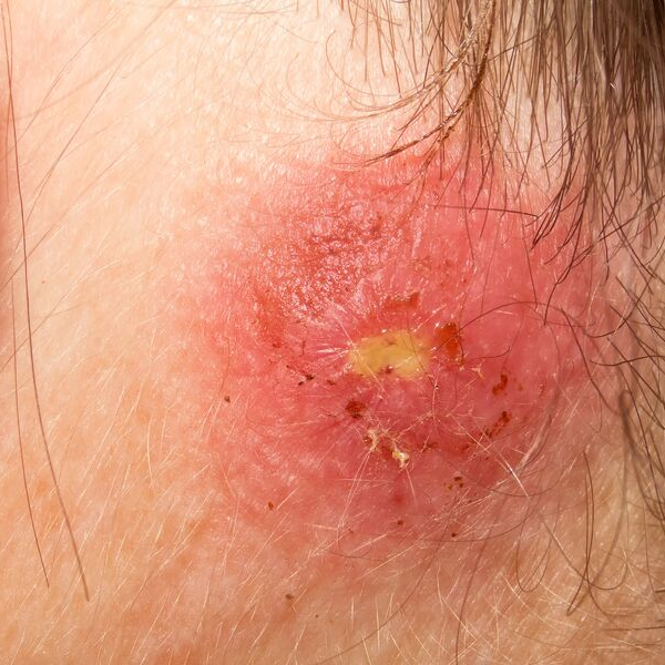 Staph Infection Apotheco Pharmacy