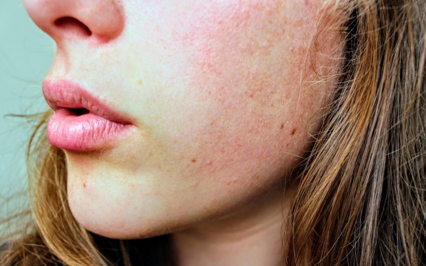 Winter Skin Diseases Prevention And Treatment