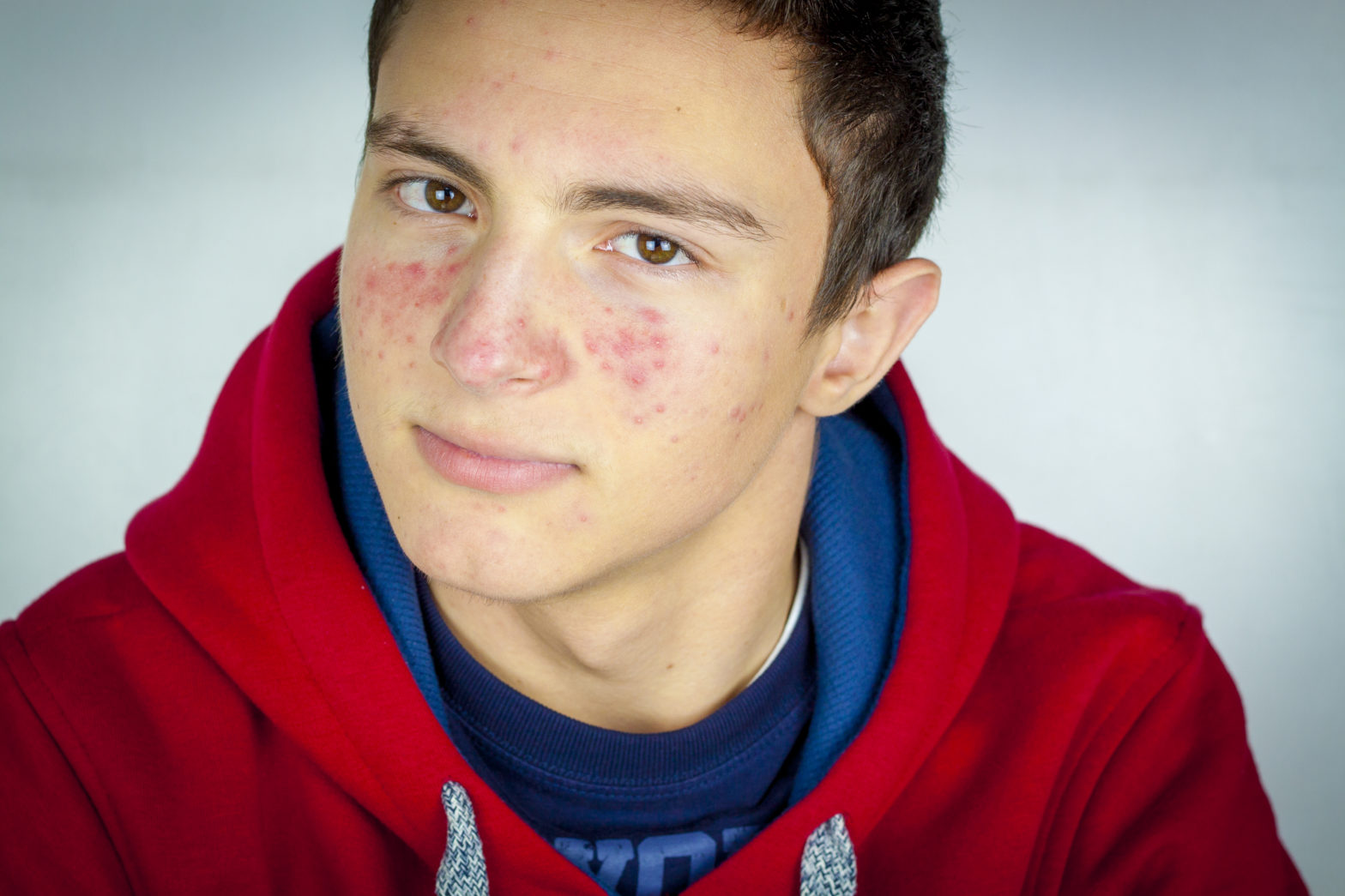 portrait-of-teenage-boy-with-acne-apotheco-pharmacy