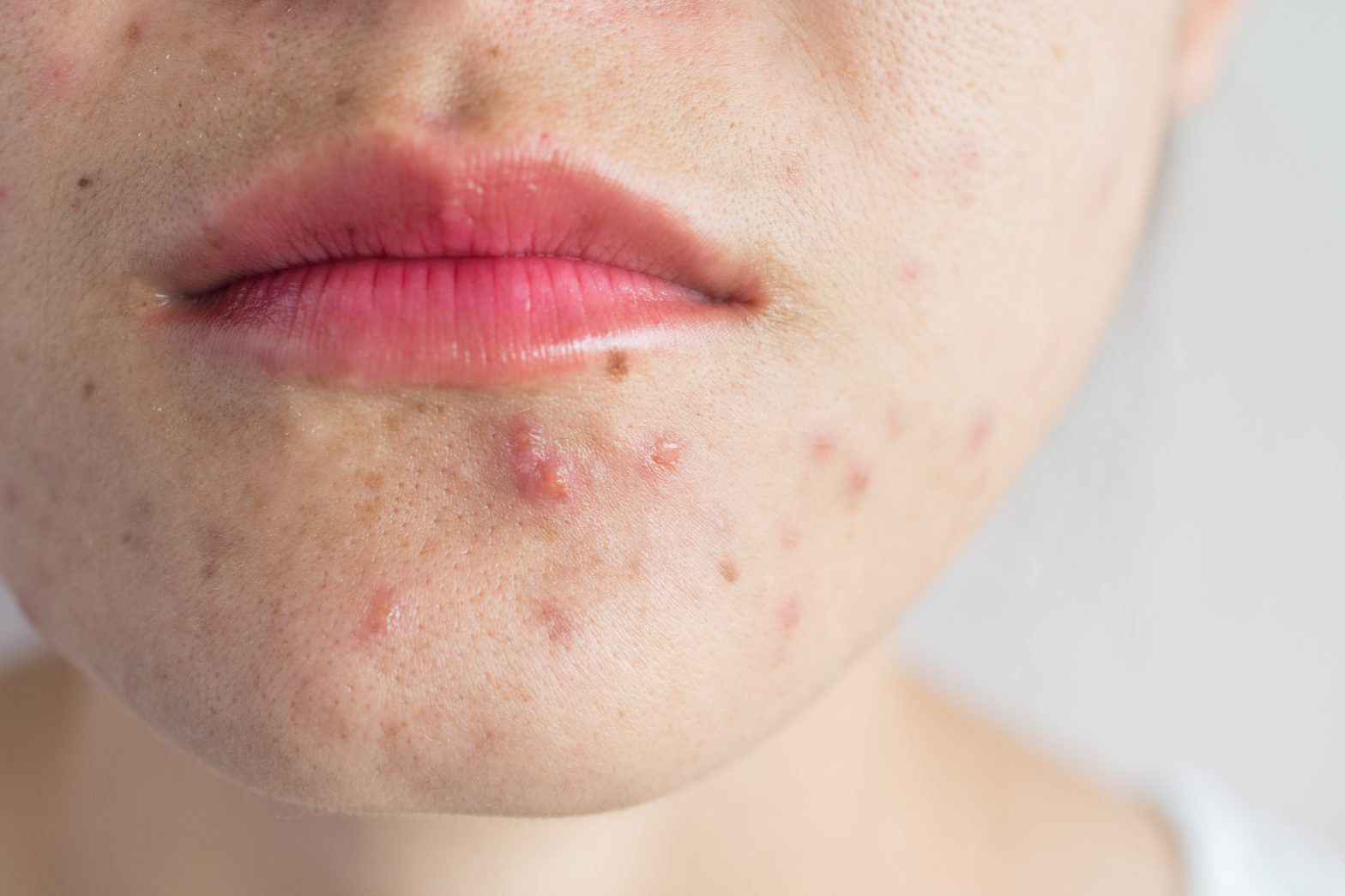 Why Do Teenagers Get Acne?